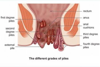 Piles Tips in Bengali 