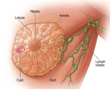 ব্রেস্ট সিস্ট হলে করণীয়