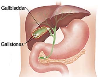 gallstone 