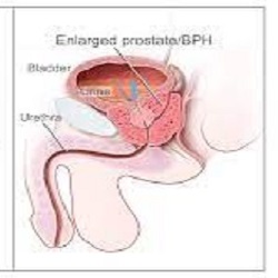 প্রস্টেট গ্রন্থি বৃদ্ধি জনিত সমস্য  