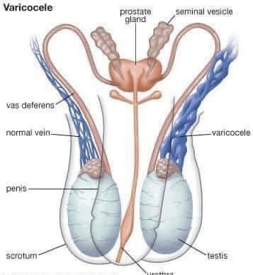 Varicocele 