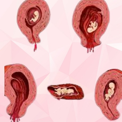 abortion miscarriage