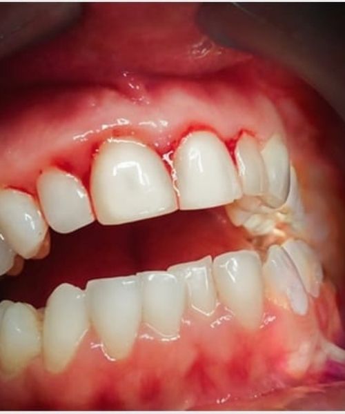 gums 