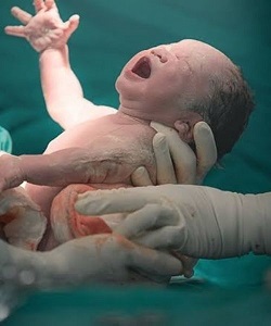 Cesarean Delivery