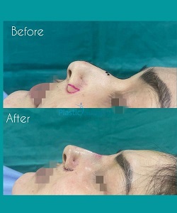 Rhinoplasty