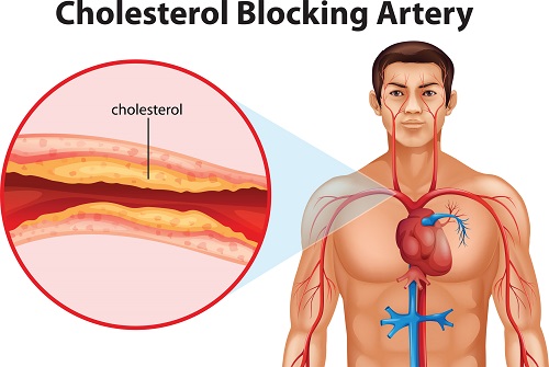 cholesterol 
