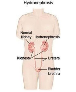 Pyelectasis Fetal Pyelectasis And Hydronephrosis