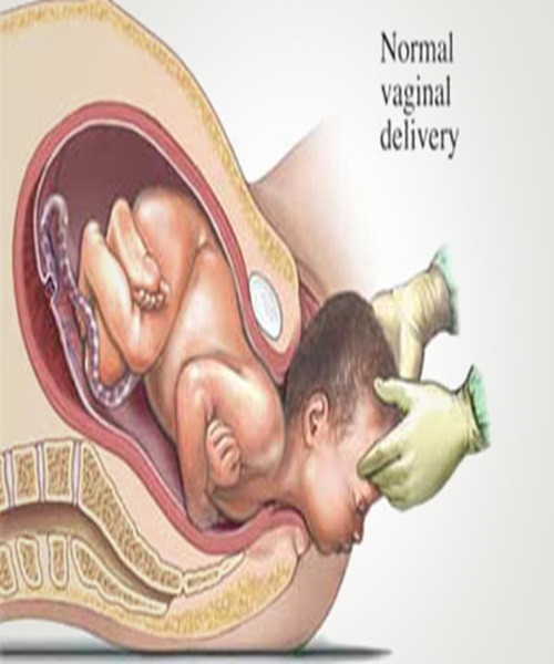 Normal vaginal delivery