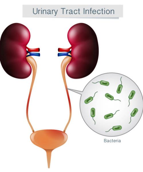 Urine infection